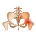 aseptic necrosis. Hip bone with damaged femoral head.